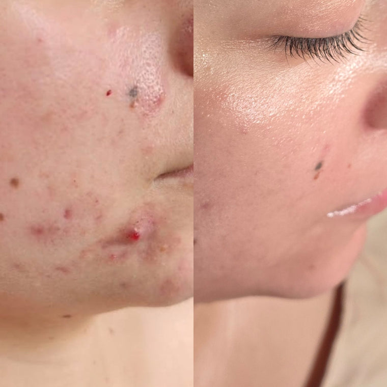 Before and after: clearer skin during the Clear Skin Journey acne program at Oregon Glow in Junction City, OR