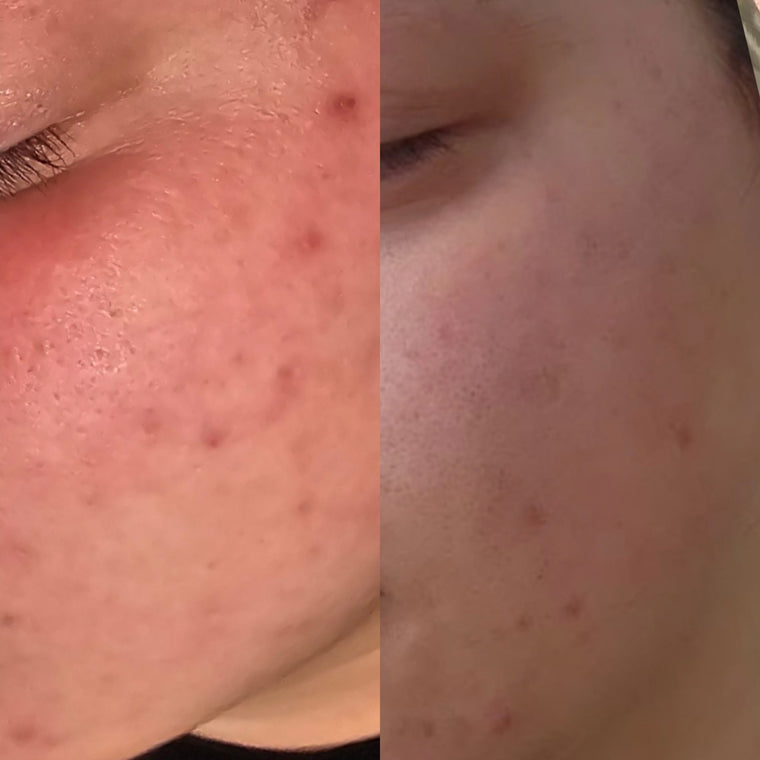 Before and after: clearer skin after acne treatment at Oregon Glow in Junction City, OR
