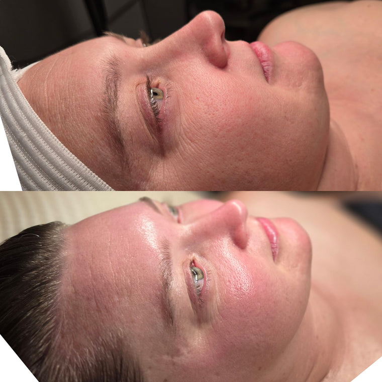 Before and after: calmer, clearer skin after an advanced facial at Oregon Glow in Junction City, OR