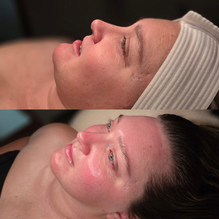 Before and after: smoother skin texture after facials at Oregon Glow in Junction City, OR