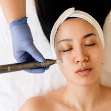 Microneedling Package 3 sessions