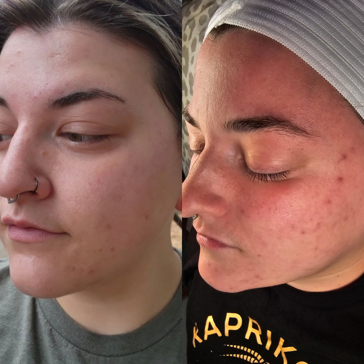 Before and after: clearer cheeks and fewer breakouts after acne treatment at Oregon Glow in Junction City, OR