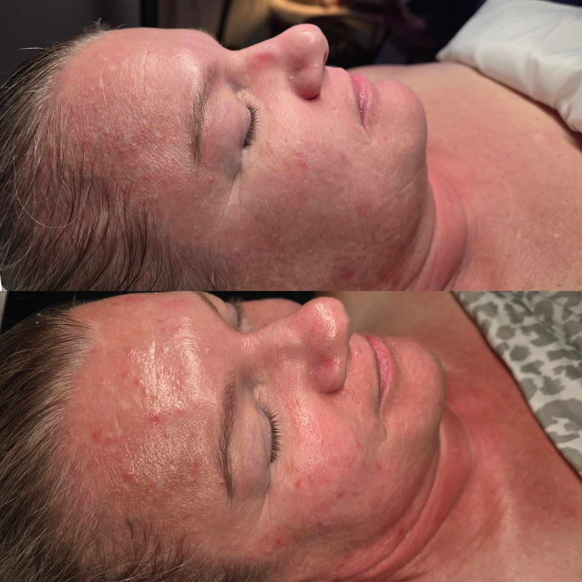 Before and after: smoother forehead texture after facials at Oregon Glow in Junction City, OR