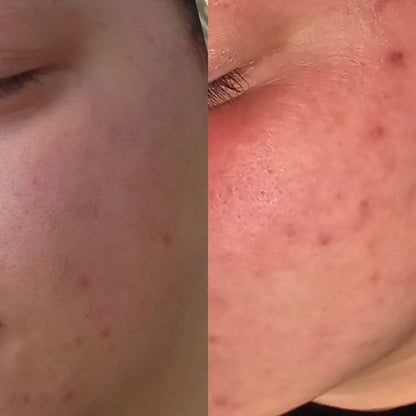 Clear & Confident Acne Bootcamp Starter Package