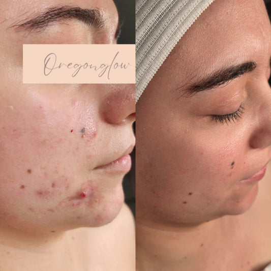 Clear & Confident Acne Bootcamp Starter Package