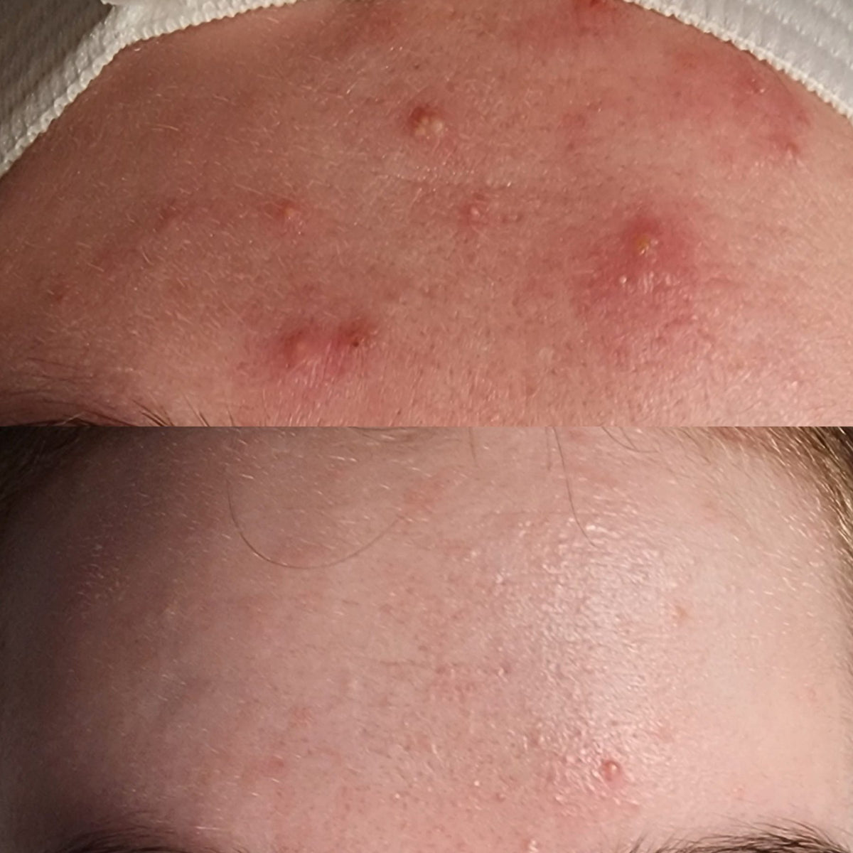 Before and after: forehead acne at Oregon Glow in Junction City, OR