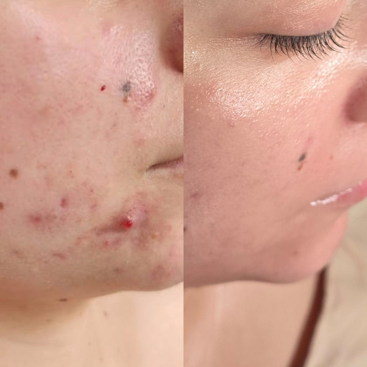 Before and after: clearer skin during the Clear Skin Journey acne program at Oregon Glow in Junction City, OR