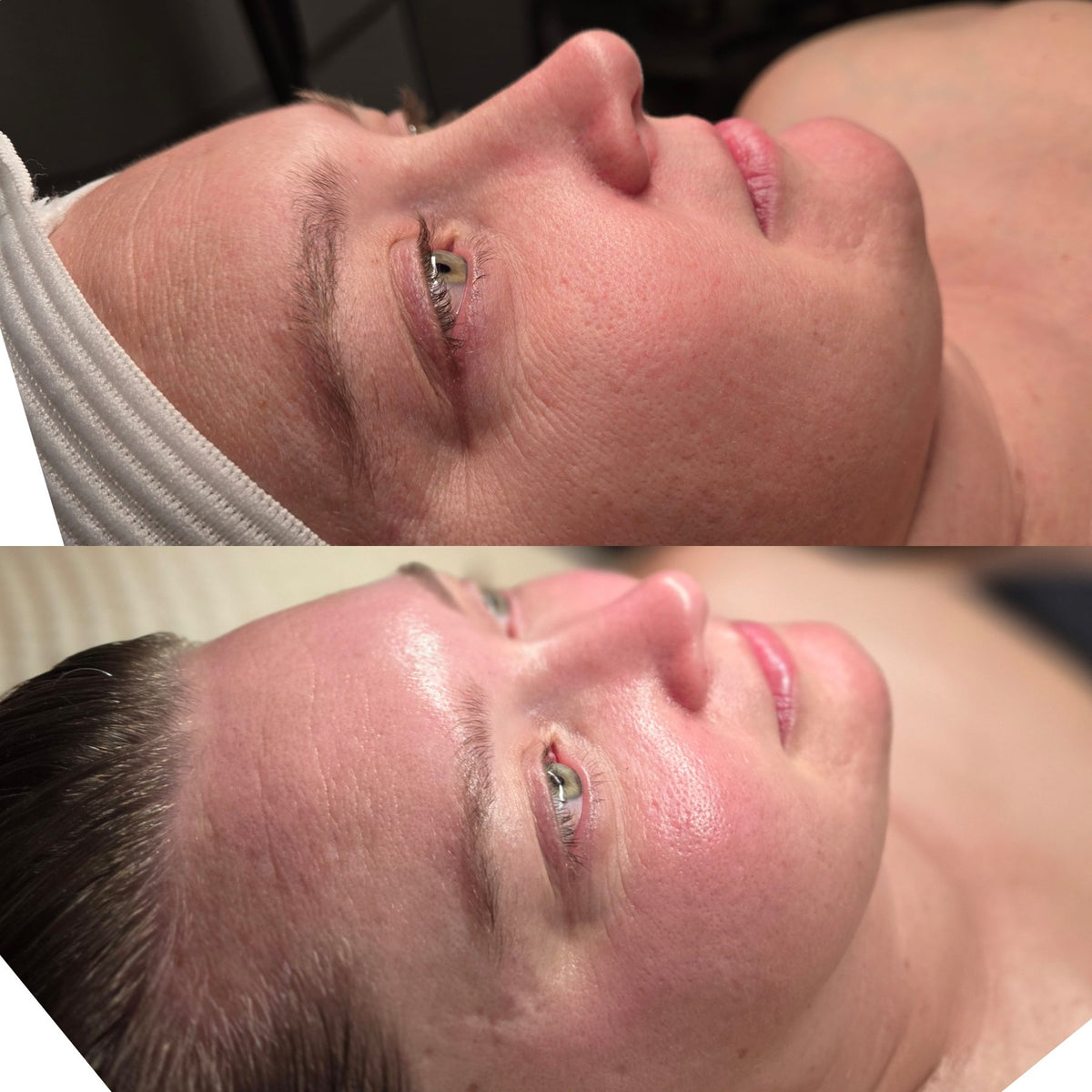 Before and after: calmer, clearer skin after an advanced facial at Oregon Glow in Junction City, OR