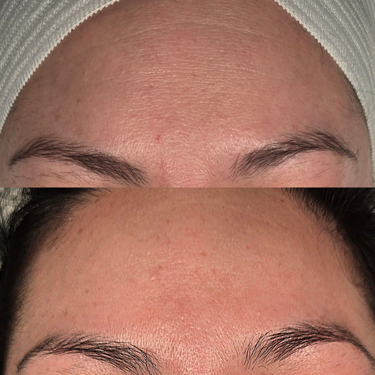 Before and after: smoother forehead texture after 3 microneedling treatments at Oregon Glow in Junction City, OR